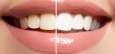 Domácí bělení zubů jako trend současnosti. Na co si dát pozor?