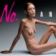 Itálie zakázala nahou anorektičku