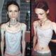 Šílené oběti anorexie