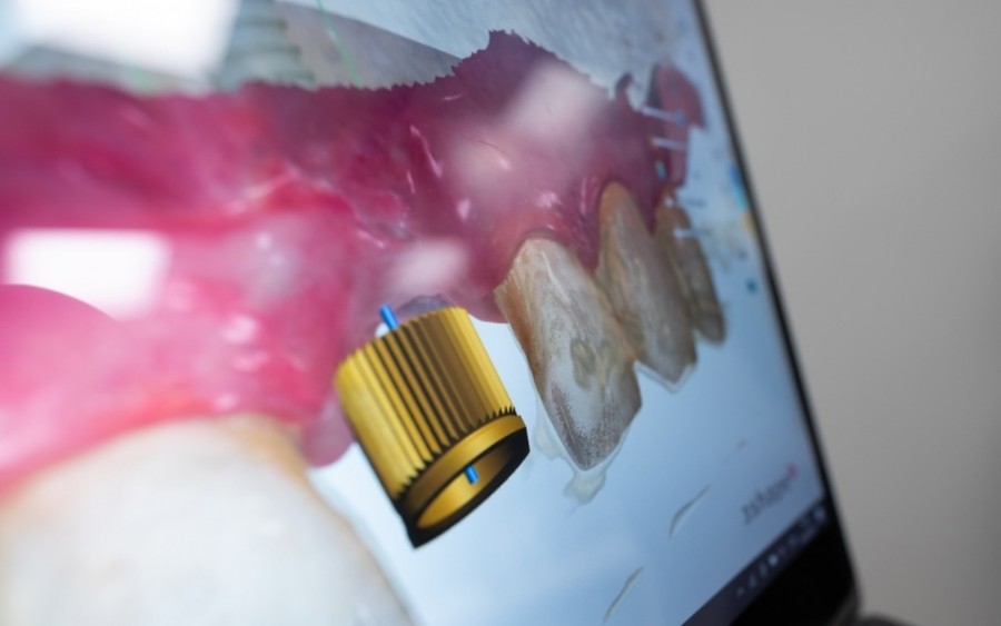 Zubní implantát