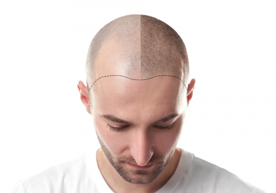 Léčba alopecie