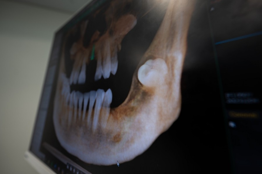 Zubní implantát
