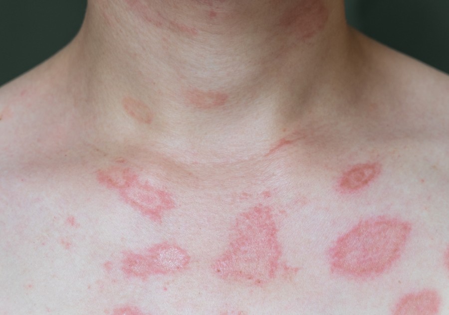 Kožní alergie